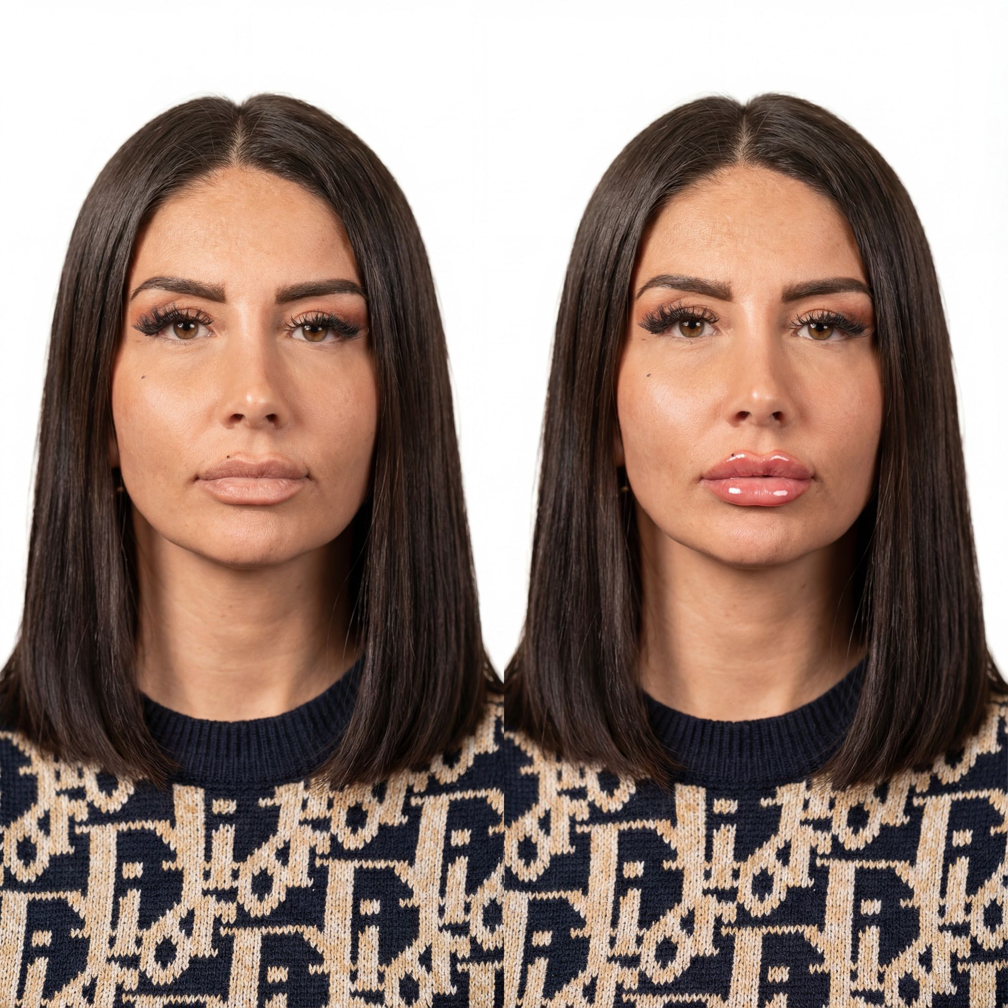 Plumpy Vorher-Nachher Ergebnis